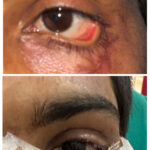 स्किन ग्राफ्टिंग से मरीज के पलक का सफल पुनर्निर्माण