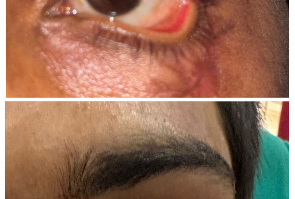 स्किन ग्राफ्टिंग से मरीज के पलक का सफल पुनर्निर्माण